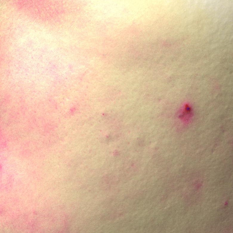 STAN ZACZERWIENIEŃ PO 28 DNIACH